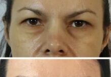 Что такое блефаропластика и ее особенности?