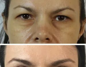 Что такое блефаропластика и ее особенности?