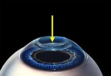 Лазерная коррекция зрения: какой метод лучше?