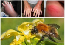 Укус осы: как снять отек?