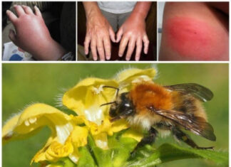 Укус осы: как снять отек?