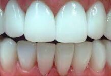 Установка циркониевых коронок