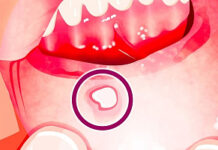 Где лучше лечить воспаления слизистой оболочки в полости рта?