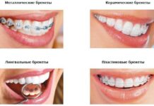 Методы и способы исправления прикуса