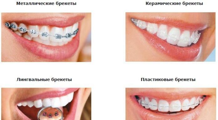 Методы и способы исправления прикуса