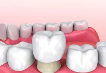 Коронка на зуб — описание, плюсы и минусы