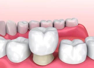 Коронка на зуб — описание, плюсы и минусы