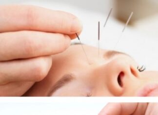 Что такое иглорефлексотерапия?