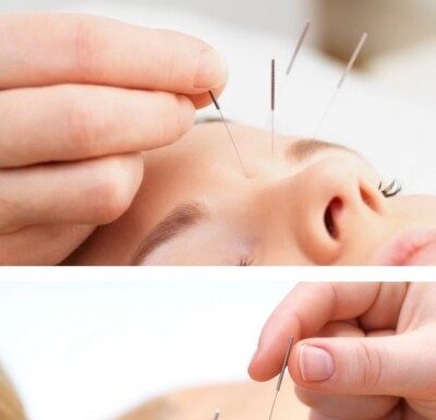 Что такое иглорефлексотерапия?