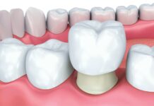 Зубные коронки — разновидности и преимущества