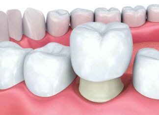 Зубные коронки — разновидности и преимущества