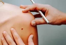 Удаление папиллом лазером: эффективный метод борьбы с нежелательными новообразованиями