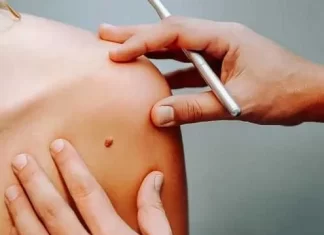 Удаление папиллом лазером: эффективный метод борьбы с нежелательными новообразованиями