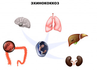 Эхинококкоз: диагностика и современные методы лечения