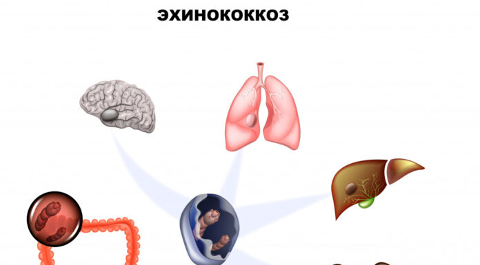 Эхинококкоз: диагностика и современные методы лечения