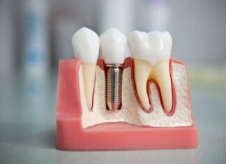 Как происходит протезирование зубов?