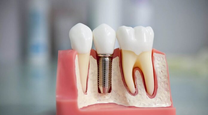 Как происходит протезирование зубов?