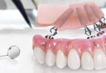 В каком случае доктор применяет технику All-on-4?