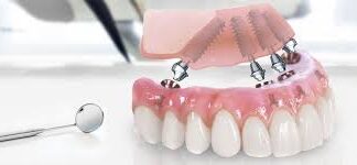 В каком случае доктор применяет технику All-on-4?