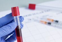 Красная волчанка: симптомы и изменения в анализе крови