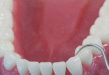 Циркониевые коронки для реставрации жевательных зубов — прочность и эстетика без компромиссов