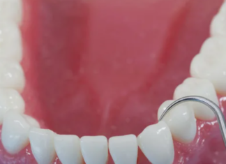 Циркониевые коронки для реставрации жевательных зубов — прочность и эстетика без компромиссов