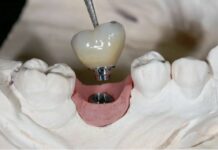 Имплантация зубов: когда протезы и мосты не подходят