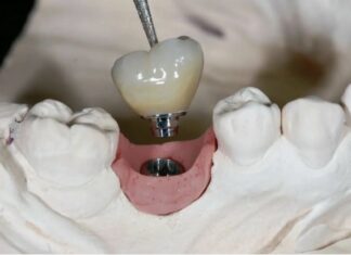 Имплантация зубов: когда протезы и мосты не подходят