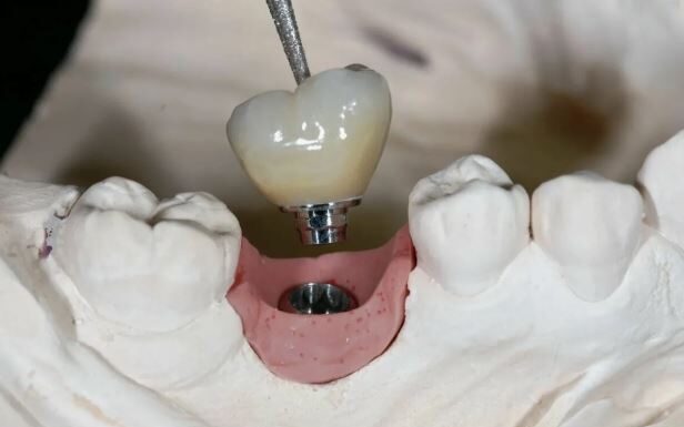 Имплантация зубов: когда протезы и мосты не подходят